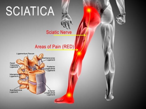 physical therapy for sciatica