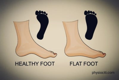flat feet exercises