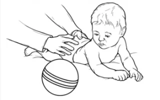 congenital torticollis