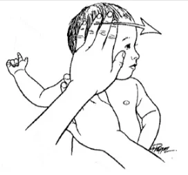 congenital torticollis