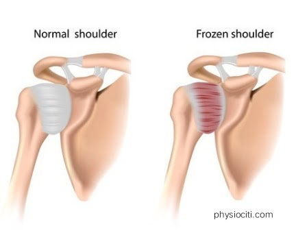 frozen shoulder exercises