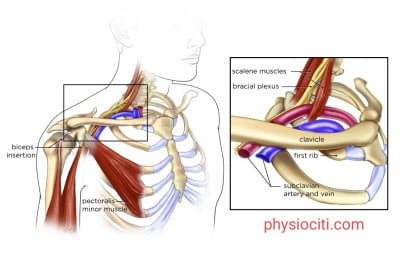 thoracic outlet syndrome