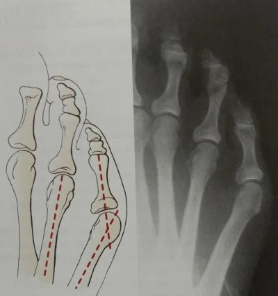 tailor's bunion type III