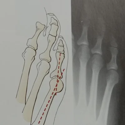 tailor's bunion type I