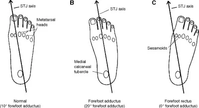 rectus foot for hallux limitus