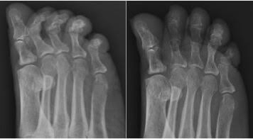 claw toe X-ray