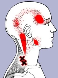 CERVICOGENIC HEADACHE EXERCISES
