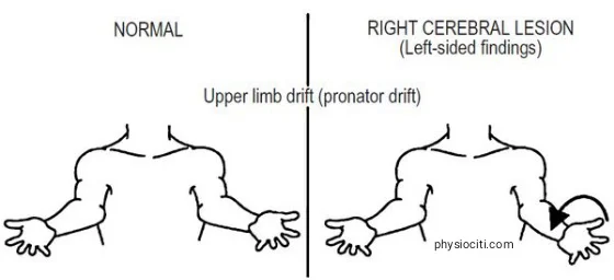 barre's test