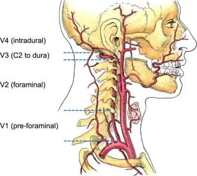 vertebrobasilar insufficiency