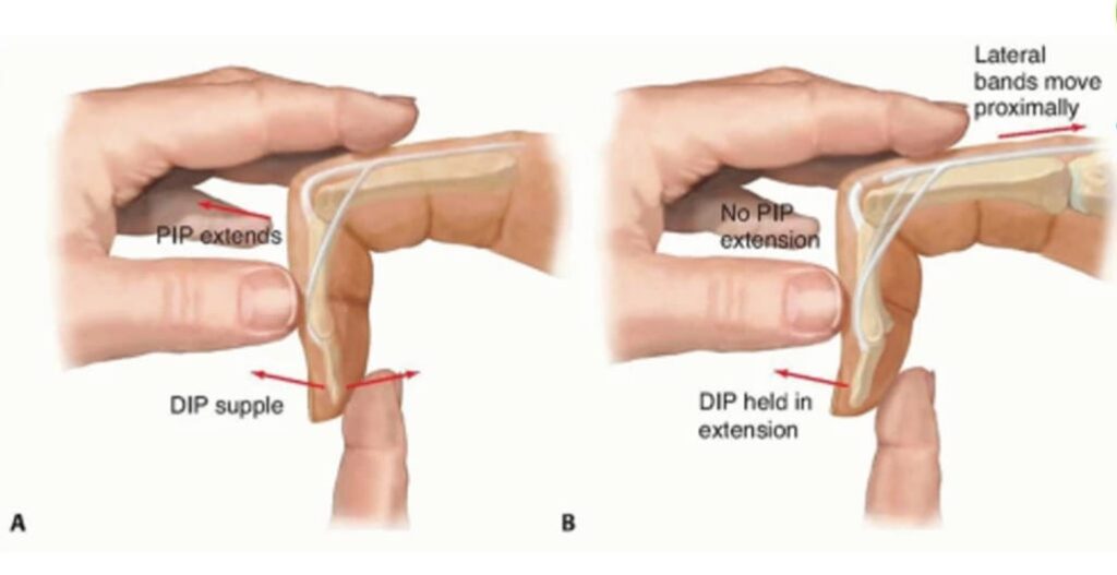 elson test for boutonniere deformity