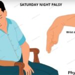 saturday night palsy