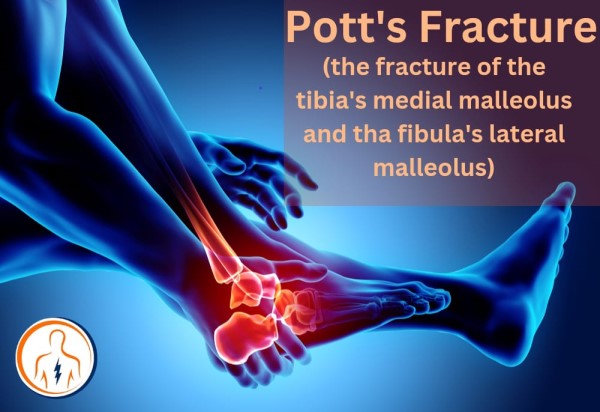 pott's fracture